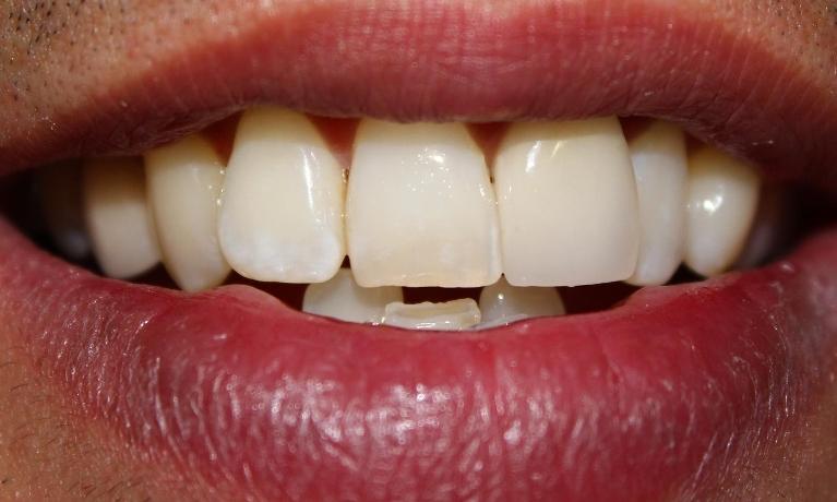 Old-Composite-Filling-After-Image