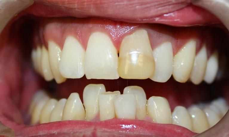 Old-Composite-Filling-Before-Image